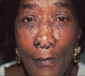 <p>Multisystem granulomatous disorder of unknown cause</p>