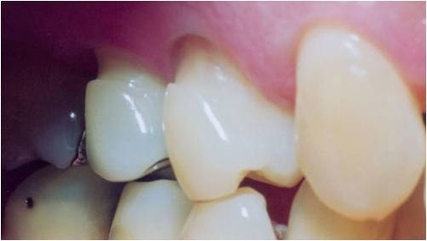 <p>Angular notch at the gumline caused by bending forces applied to the tooth.</p><p>For of non-carious tooth tissue loss that occurs along the gingival margin.</p>