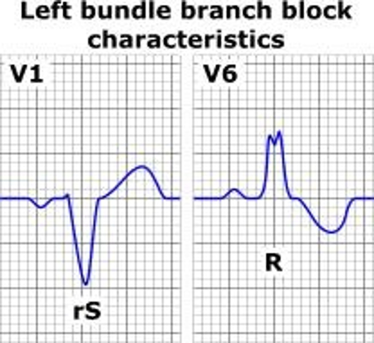 <p>ST depression usually occurs but is not indicative of ischemia; onset of LBBB during ETT is an indication to stop the test.</p>