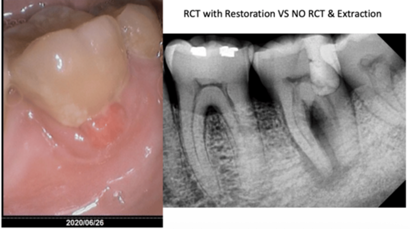 <p>Is #18 restorable or non-restorable?</p>