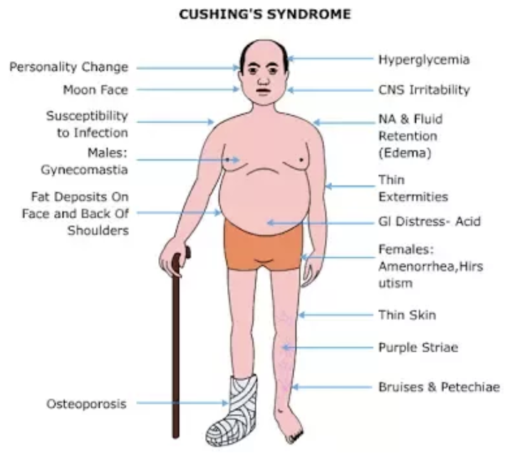 <ul><li><p>commonly occurs when a person takes sustained <strong>high does of glucocorticoid medicin</strong>e, but it can be produced by either:</p></li></ul><p>1) a<strong> pituitary tumor</strong> that secretes <mark data-color="yellow" style="background-color: yellow; color: inherit;">excessive ACTH</mark></p><p>2) a <strong>benign tumor </strong>of the adrenal that <mark data-color="yellow" style="background-color: yellow; color: inherit;">secretes excessive cortisol </mark>without requiring ACTH stimulation</p>