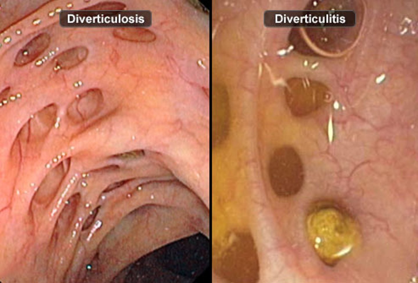 <p>The presence of diverticula in the colon without inflammation.</p>