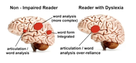 * showed less activity in core areas for reading
* more activity in right hemisphere areas
* dysfunction in left hemisphere posterior reading circuits
* pre-reading stage: thinner cortex in primary auditory and visual areas