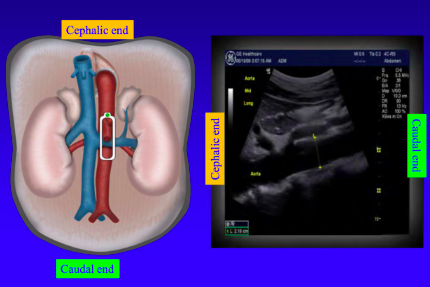 caudal (towards feet)