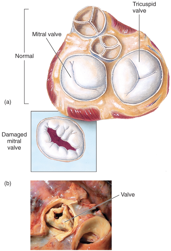 <p>follows overt or subclinical pharyngitis in children or scarlet fever, lasts 3 - 6 months, can lead to carditis with extensive valve damage possible, degree of damage not apparent until middle age</p>