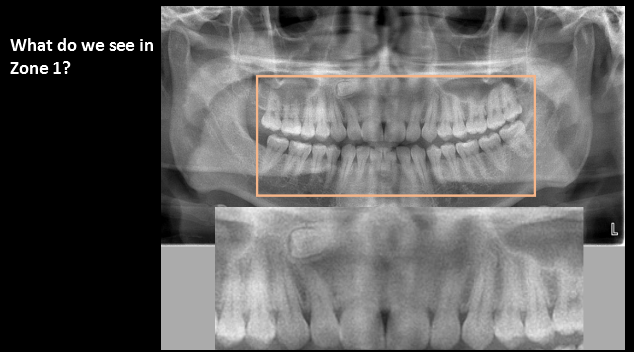 <ul><li><p>supernumerary teeth/impacted tooth</p></li></ul><p></p>