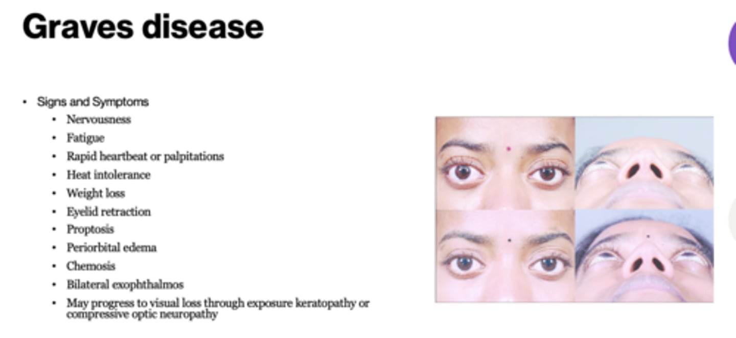 <p>Graves disease (hyperthyroidism)</p>