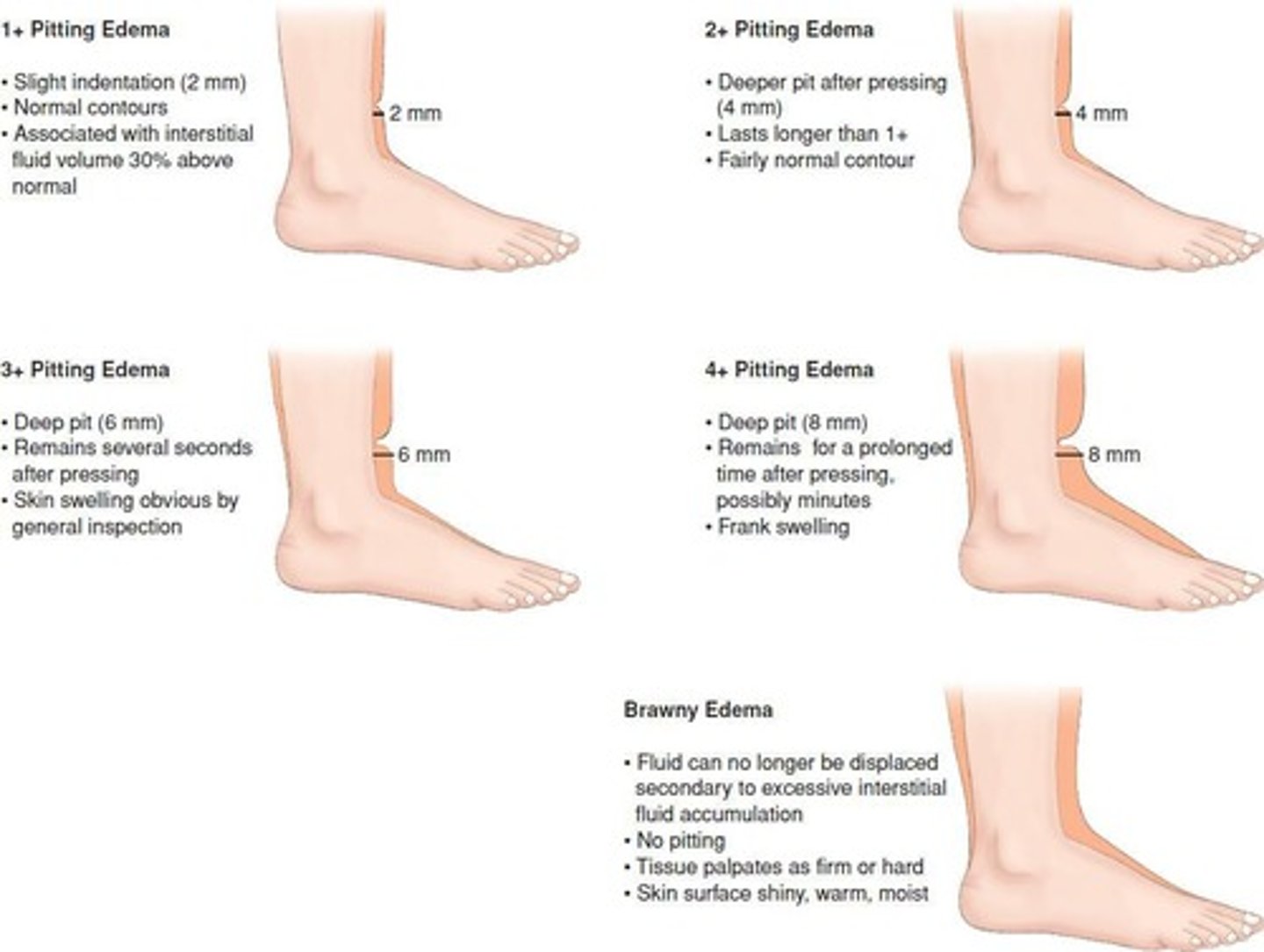 <p>A type of edema where an indentation remains after pressure is applied, graded from +1 to +4.</p>