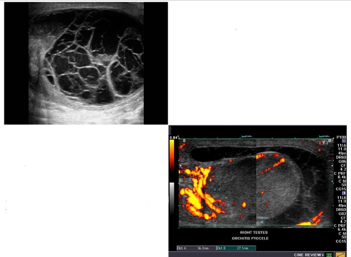 <p>What is result from abscess rupture into existing hydrocele or directly into space between tunica vaginalis layers, both have septations &amp; loculations;chronically skin thickening and calcifications?</p>