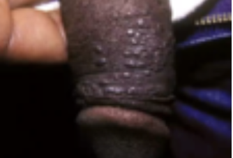 <p>Single‬ or‬‭ multiple,‬‭ moist,‬ fleshy papule; STI‬ caused ‬‭by ‬‭human‬ papillomavirus‬</p>