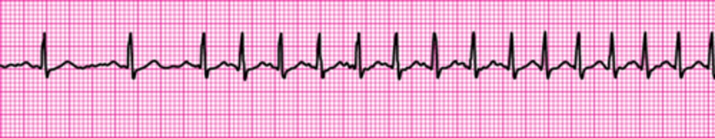 <p>Supraventricular Tachycardia</p>