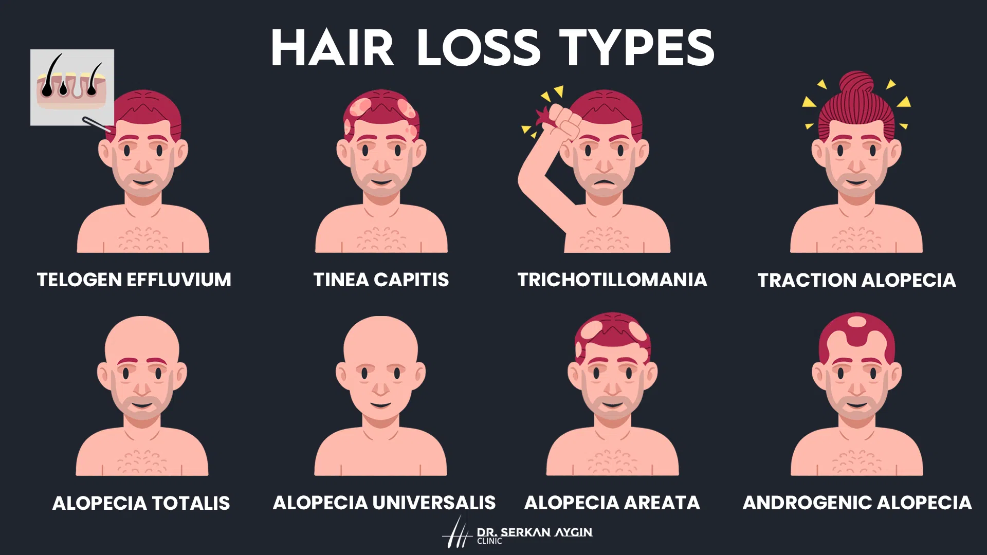 <p>good hx needed</p><p><u>non-scarring:</u><br>hormonal<br>tight hair buns<br>immune system (alopecia areata)<br>telogen effluvium (systemic cause)<br>-pregnancy<br>-COVID<br>-mx<br>-nutrition deficiency</p><p><u>scarring:</u><br>follicles destroyed by inflammation<br>-ex: discoid lupus</p>