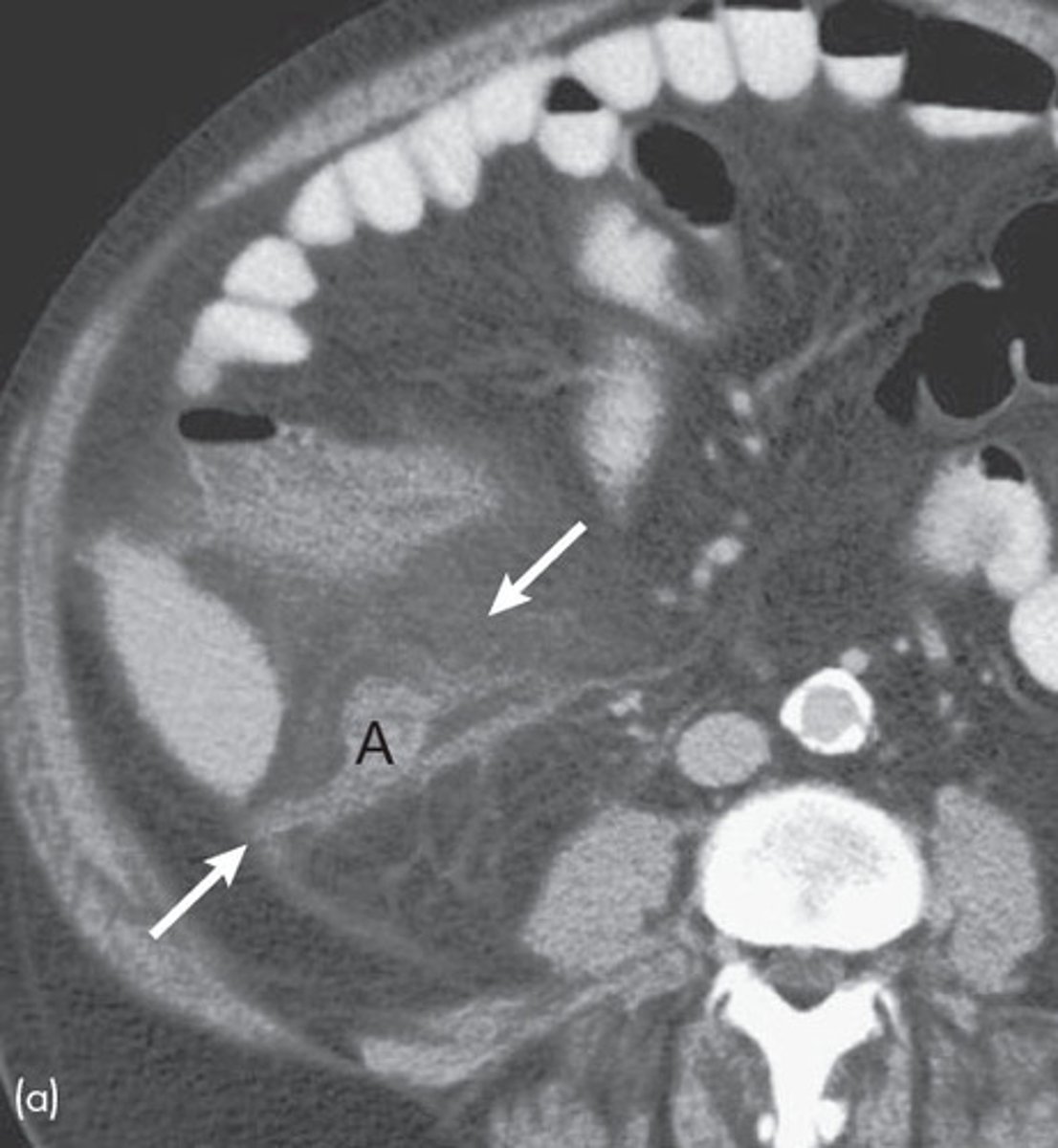 <p>Fat stranding around the appendix (indicates inflammation)</p>