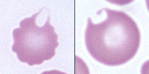 <p>rbc w blister-like vesicle, wc may rupture, leaving a “bite-shaped” defect, or one or two horn-like projections in the same side of the cell</p>