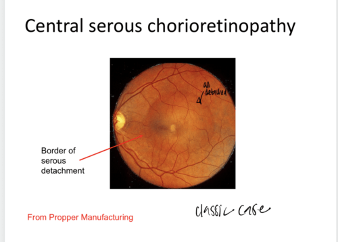 <p>What is central serous retinopathy?</p>