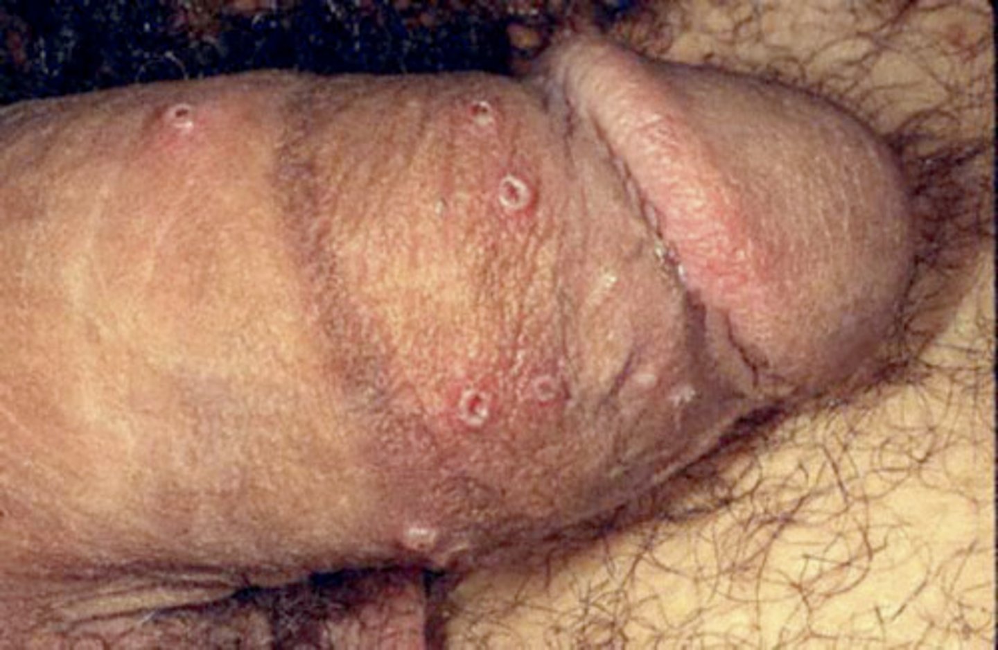 <p>Welke virale infectie is dit?</p>