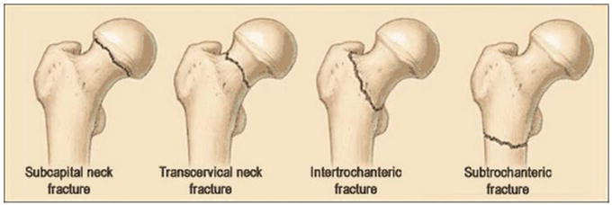 <p>How are subtrochanteric fractures treated?</p>