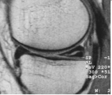 <p>meestal degeneratieve basis en verdeeld meniscus craniaal en caudaal</p>