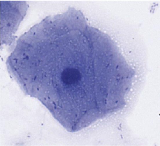 <p>Kantig och tunn cell med pyknotisk kärna</p>