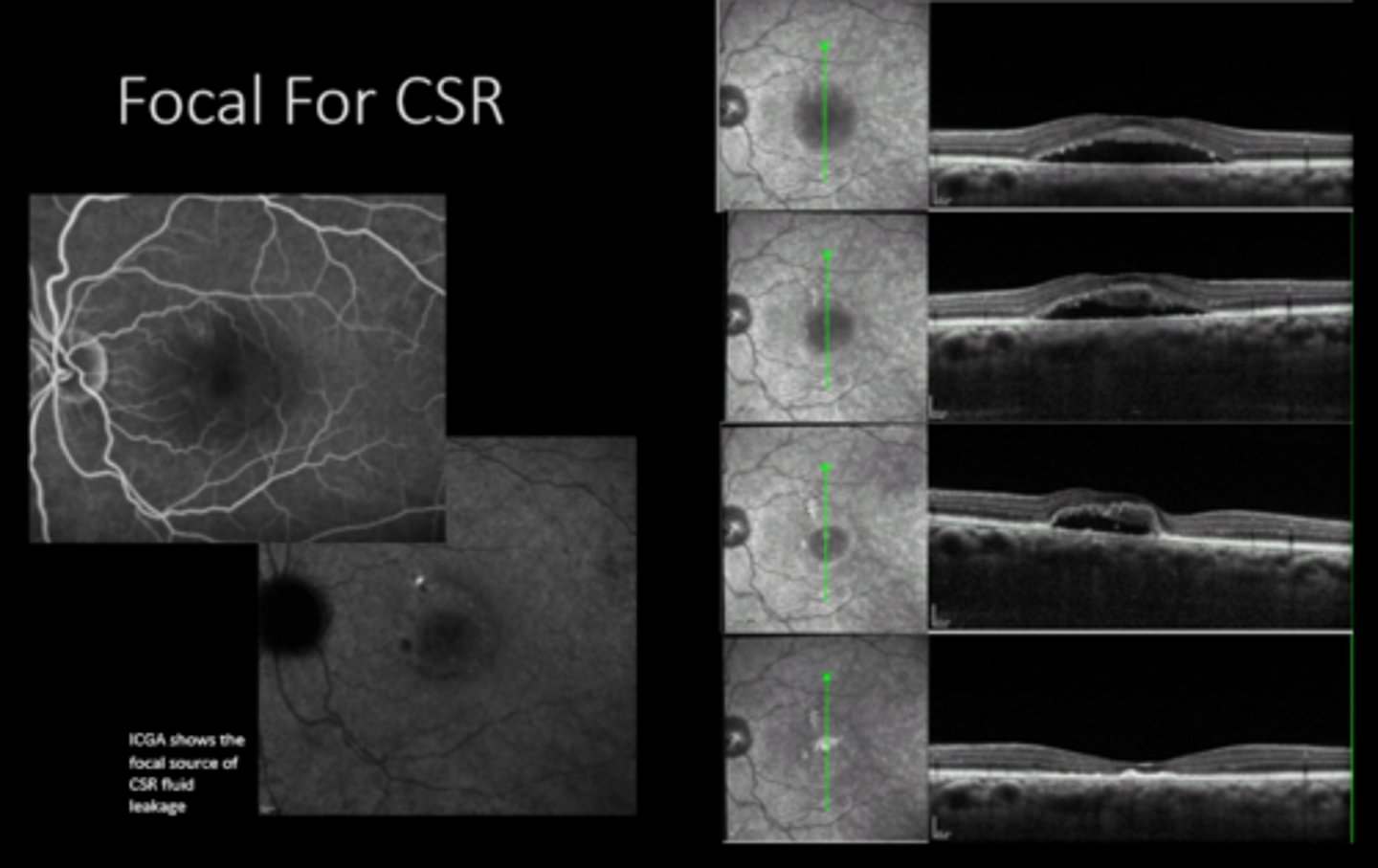 <p>What do we use focal laser for? 4 things.</p>