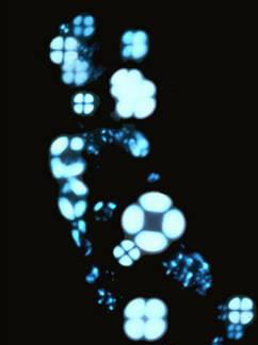 <p>lipiduria → d/t hypercholesterolemia</p><p>maltese cross!</p>