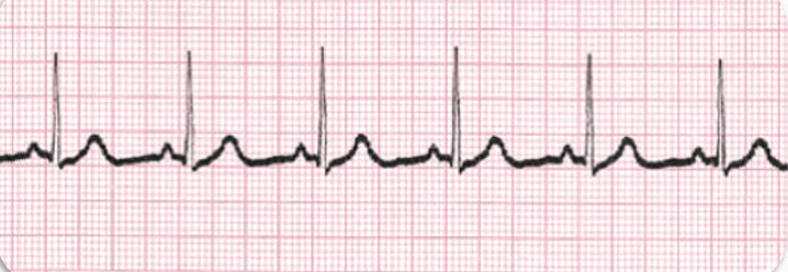 <ul><li><p class=""><strong>Rate</strong>: 60 to 100 (ventricular and atrial)</p></li><li><p class=""><strong>Rhythm</strong>: Regular</p></li><li><p class=""><strong>P waves</strong>: Uniform and upright</p></li><li><p class=""><strong>P to QRS Ratio</strong>: 1:1</p></li><li><p class=""><strong>PR Interval</strong>: 0.12 to 0.20 seconds</p></li><li><p class=""><strong>QRS Complex</strong>: Less than 0.12 seconds</p></li></ul><p></p>