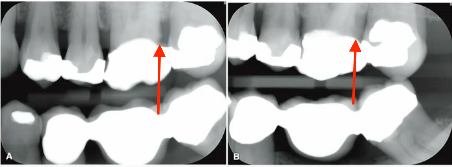 <p>why can recurrent caries be seen on image A but not image B </p>