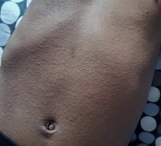 <ul><li><p>Caused by a toxin produced by <strong>Group A </strong><span><strong>β</strong></span><strong>-Hemolytic Streptococcus (GABHS)</strong>, the same bacteria that causes Strep Throat.</p></li><li><p><strong>Manifestations:</strong> <strong>"Sandpaper" rash</strong> (finely papular, rough to the touch), usually starting on the neck and trunk and sparing the mouth area (circumoral pallor), and <strong>"strawberry tongue"</strong> (white coating with red papillae, later shedding to be just red and swollen).</p></li><li><p><strong>Risk:</strong> Requires antibiotic treatment to prevent long-term complications like <strong>rheumatic fever</strong> or <strong>post-streptococcal glomerulonephritis (PSGN)</strong>.</p></li><li><p>droplet</p></li></ul><p></p>