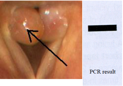 A patient comes to your clinic with the structures shown at right on his vocal cords. You take a biopsy of the structure indicated by the arrow. PCR primers are prepared comple-mentary to the 3' ends of a bacterial gene, and a reaction is performed on the biopsied tissue. The results are shown after electrophoresis. What is the best interpretation of this data? 

\
A. The PCR has been done wrong. One primer should be complementary to the 3' end and the other should be complementary to the 5' end of the gene. 

B. The patient's macrophages are in the process of digesting the bacteria and releasing the DNA. 

C. The patient has a granuloma, and may need long term antibiotics to treat it. 

D. The patient has a tumor, which was caused by insertion of bacterial DNA. 

E. The bacterium is actively replicating its DNA, which was detected by the PCR. 