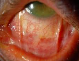 <p>abnormal adhesion bn eyeball and lids</p><p>caused by pempigous</p>