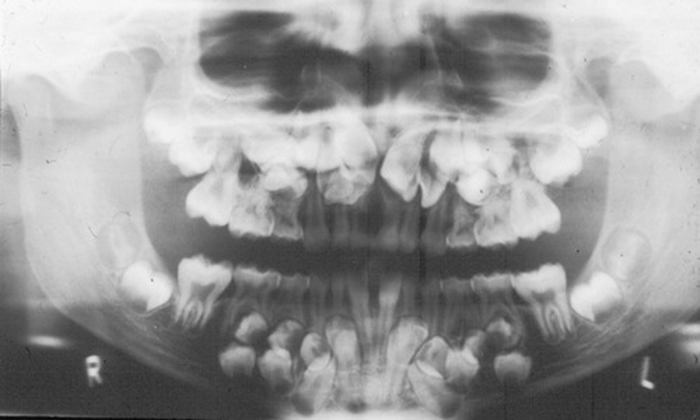 <p>cleiodcranial dysplasia</p>