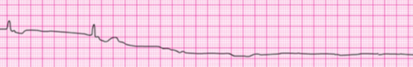 <p>A patient was in refractory ventricular fibrillation. A third shock has just been administered. Your team looks to you for instructions. Your immediate next order is:</p><p>1. Perform endotracheal intubation.</p><p>2. Resume high-quality chest compressions.</p><p>3. Check the carotid pulse.</p><p>4. Give atropine 1 mg IV.</p><p>5. Give amiodarone 300 mg IV.</p>