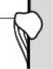 <p>what type of abnormal periosteum is this?</p>