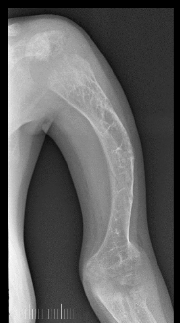 <p>what is seen here for this case of osteogenesis imperfecta?</p>