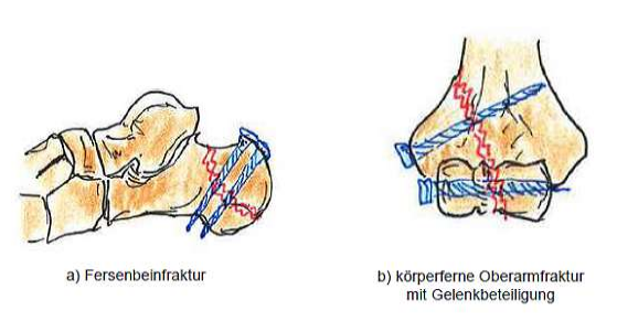<p>Operative Frakturbehandlung</p><p><strong>Schraubenosteosynthese</strong></p><ul><li><p>Druck ausüben auf Fraktur</p></li><li><p>vermeiden der Verdrehung</p></li></ul><p></p>