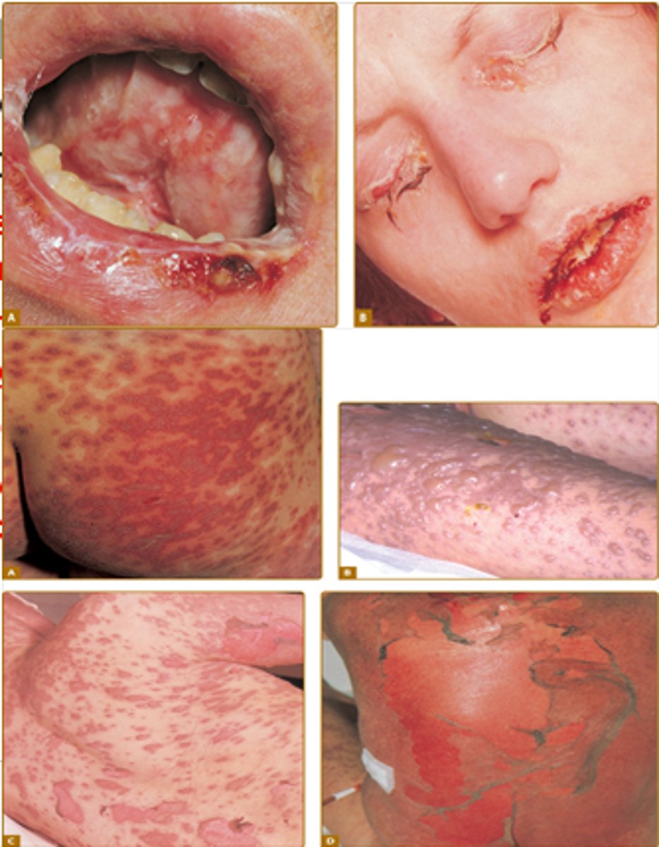 <p>Prodrome rash SJS/TENS</p>