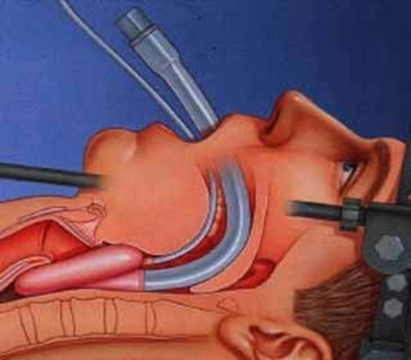 <p>An airway consisting of a tube and small mask that is fitted internally over the patient's larynx.</p>