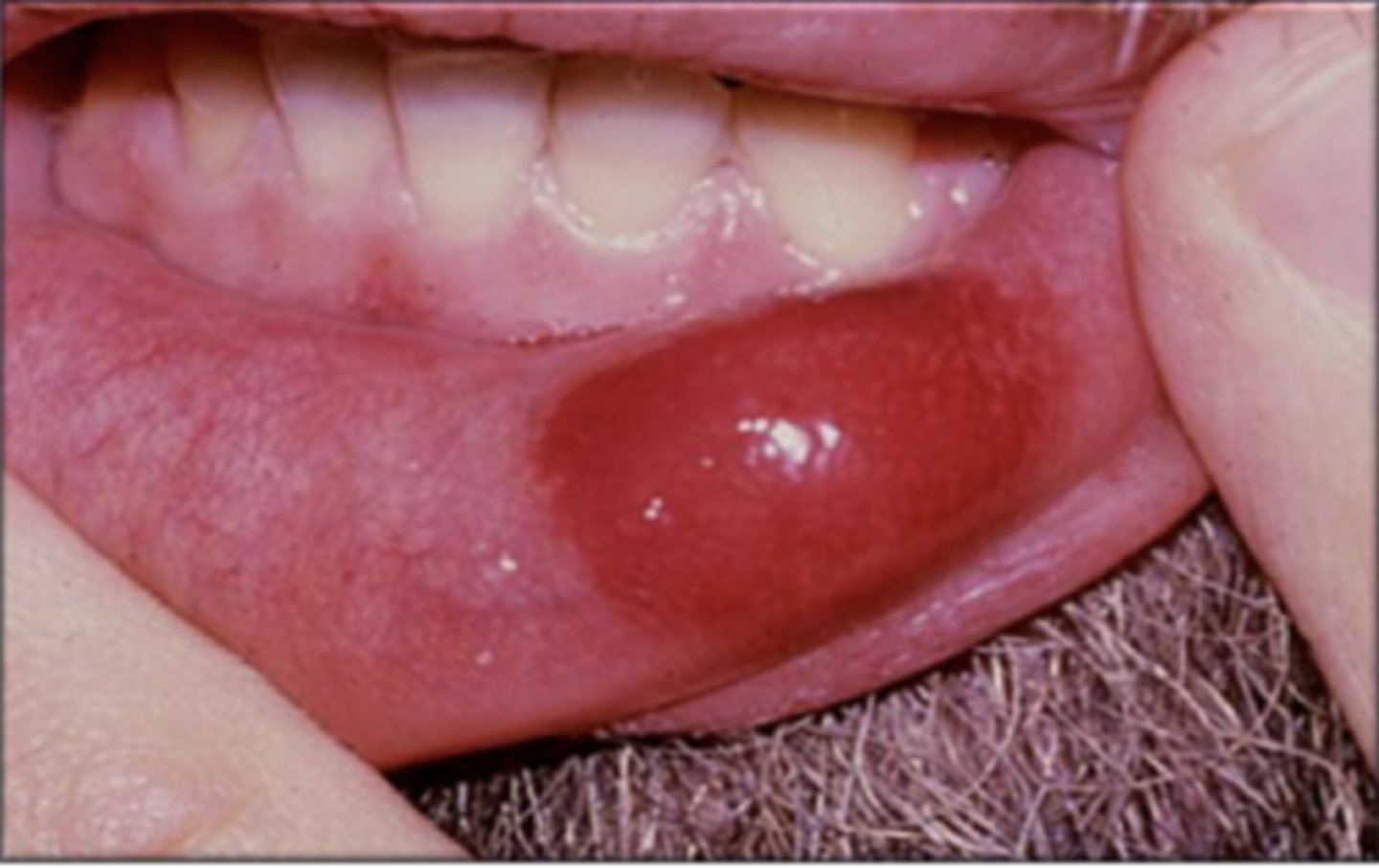 <p>• associated with trauma</p><p>• common location: buccal/labial mucosa</p>