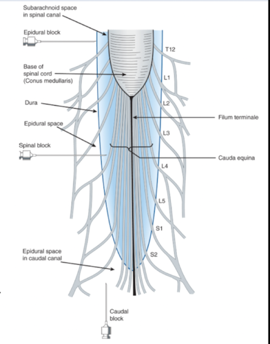 used for lower limb and pelvic surgery

injected into subarachnoid space caudal to L2

dependent on dose, can achieve full anesthesia of all distal structures