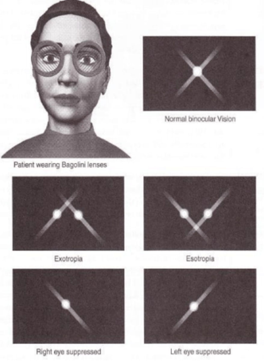 <p>test which utilizes a striated plano lens over one eye oriented at 45 degrees and at 135 degrees in the other eye to assess fusion. A patient with fusion will see an X image. A patient with suppression will see only a single streak. A patient with strabismus will see two crosses, but they will not cross in the center.</p>