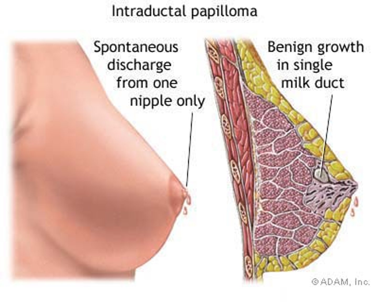 <p>Excessive growth of epithelial tissues towards duct lumen,<br>Bloody nipple discharge<br>proliferative lesion</p>