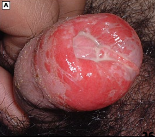 <ul><li><p><strong>Inflammation of the glans penis</strong></p><ul><li><p class="p2">Incidence ~3% of men globally</p></li><li><p class="p2">hand in hand w/ phimosis/paraphimosis</p></li></ul></li></ul><p></p>