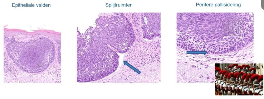 <ul><li><p>Epitheliale ‘baseloïde’ velden: Deze zijn paarser dan cellen van de stratum spinosum van de epidermis. Komt doordat deze BCC uitkomen vanuit basale laag, die wat paarser zijn dan de keranocyten die roze zijn. Het is epitheliaal wand de cellen vormen groepjes. Lymfomen bijv heb je losse cellen die geen onderlinge verband hebben</p></li><li><p>Splijtruimten/Retractieartefact: Mogelijke verklaring is dat dit wordt veroorzaakt door bewerkingen van weefsel door de patholoog om coupes te maken</p></li><li><p>Perifere pallisidering: Tumoren hebben aan de rand kerntjes waar de kernen als ‘mannetje op mannetje’ staan= pallisidering. Kenmerk die de stratum basalum ook hebben</p></li></ul><p></p>