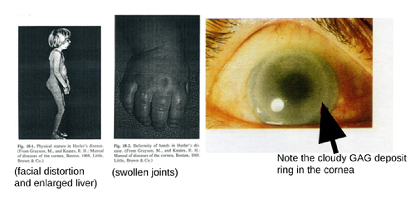 <p>-linear arrest in growth at ~1 year of age</p><p>-psychomotor retardation</p><p>-GAGs pile up in the joints and internal organs, causing a distorted facial appearance, deformed and stiff joints with an enlarged liver and spleen</p><p>-Usually fatal within a few years, due to congestive heart failure and respiratory pulmonary infections.</p>