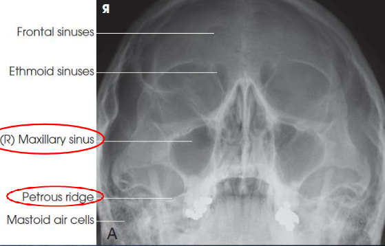 <ul><li><p>demonstrates:</p><ul><li><p>maxillary sinuses</p></li><li><p>petrous pyramids lying inferior to maxillary floor</p></li><li><p>frontal and ethmoid sinuses are distorted</p></li></ul></li><li><p>insufficient extension: petrosa are projected over the inferior portions of the maxillary sinuses</p></li><li><p>overextension: maxillary sinuses are foreshortened, and antral floors are not shown</p></li><li><p>OML in proper position:</p><ul><li><p>petrous pyramids lying immediately inferior to floor of maxillary sinsues</p></li><li><p>symmetric orbits and maxillary sinuses</p></li><li><p>MSP of head aligned with long axis of collimated field</p></li></ul></li><li><p>air-fluid levels, if present</p></li></ul><p></p>