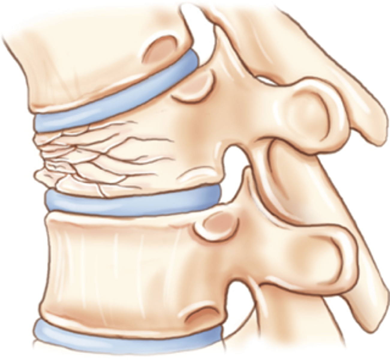 <p>Vertebral body collapses or is crushed</p>