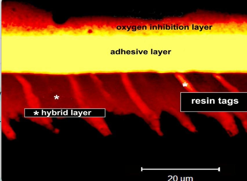<ul><li><p>the resin infiltration is helped by the presence of HEMA - hydroxyethylmethacrolate to form the <strong><em><u>hybrid zone </u></em></strong>between the tooth and the restoration - it is neither tooth nor restoration&nbsp;</p></li><li><p>this provides a strong structure - making a bond between the composite and the tooth tissue - but the bond is mainly achieved not through penetration down the dentinal tubules but the <strong>intertubular penetration - and bonding to the dentinal collage</strong>n&nbsp;</p></li></ul><p></p>