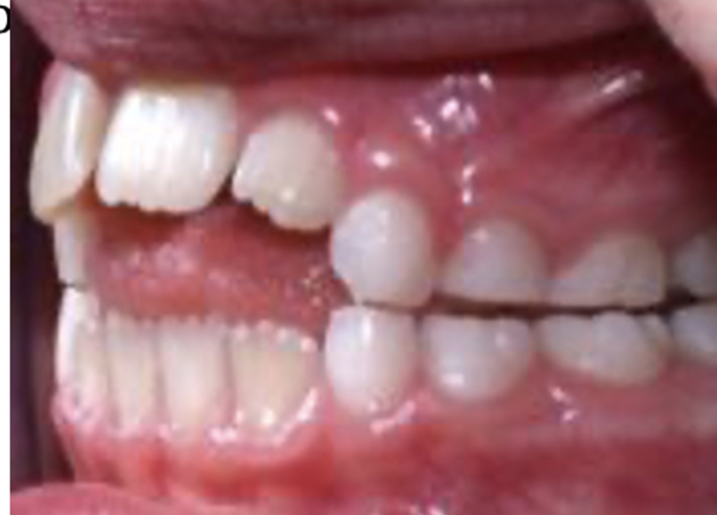 <p>The application of forceful pressure against the anterior teeth with the tongue, causing lisp</p>