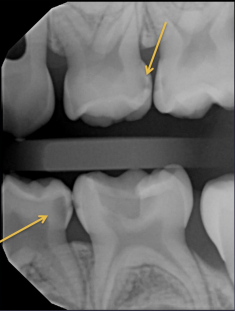 <p>bottom arrow, classify this lesion based on the ADA caries classification system </p>
