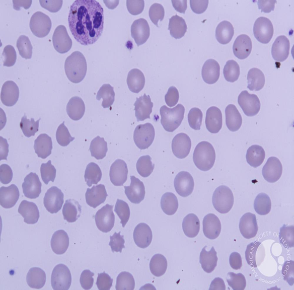 <p><span>Blister cell</span></p>